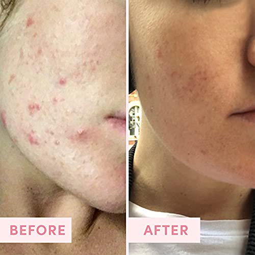 Sand & Sky Clay Mask for Face Pore Minimizer - Australian Pink Clay Detoxifying Face Mask for Pores, Kaolin Clay Mask, Bri...